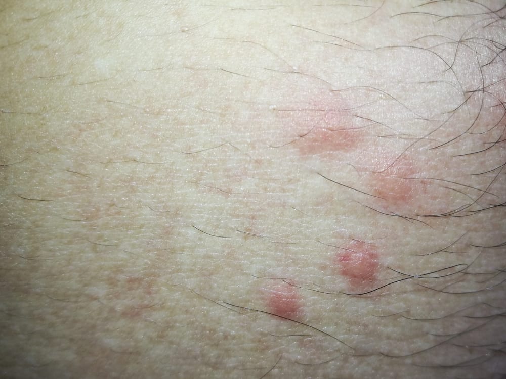 شكل لدغات البراغيث