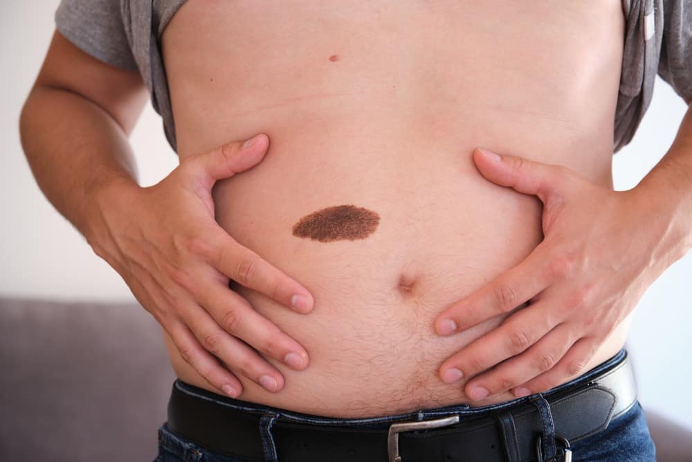 الوحمات الصباغية