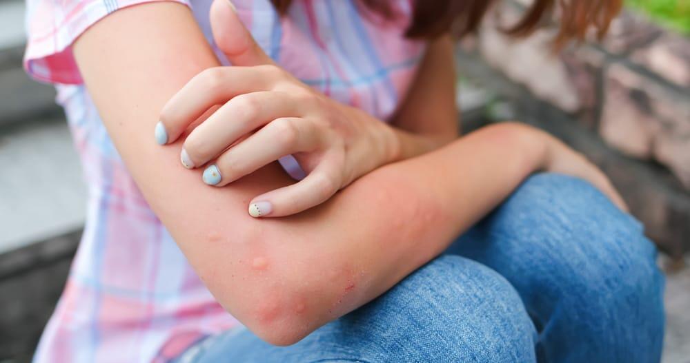 شكل لدغات البرغش