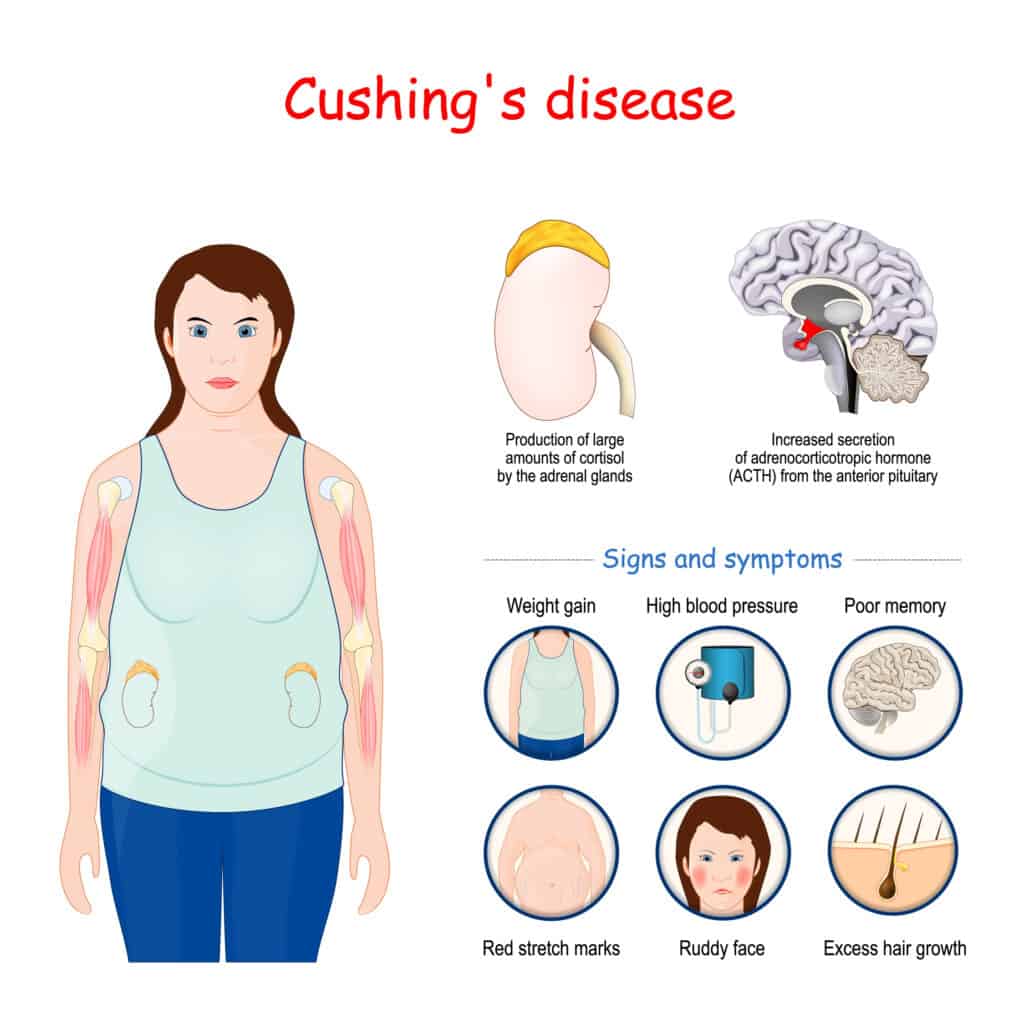 متلازمة كوشينج