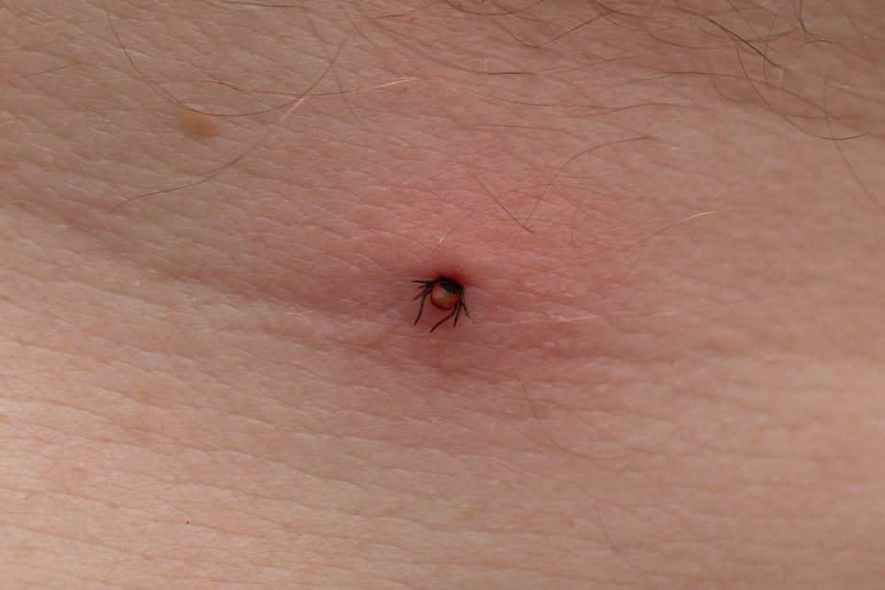 شكل لدغة القراد